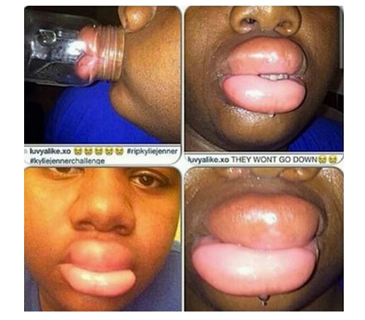 секси устни или обезобраяване?